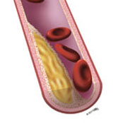 Arterial Plaque Build-up