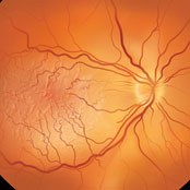 Cellophane Maculopathy