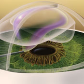 Descemet's Stripping Endothelial Keratoplasty (DSEK)