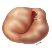 Mitral Valve Repair and Replacement